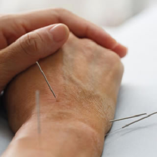 Acupuncture Image - 