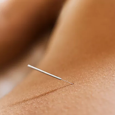 Acupuncture Image - 